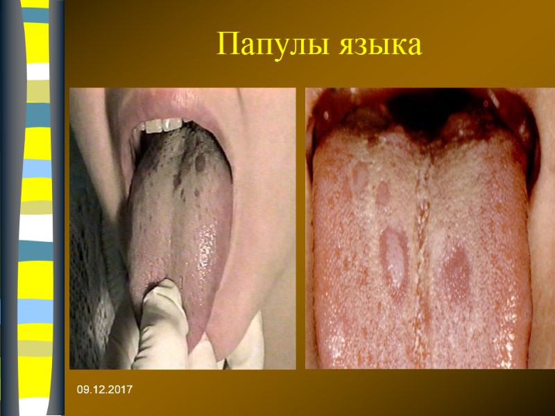 09.12.2017 Папулы языка